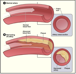 Narrowing of Artery