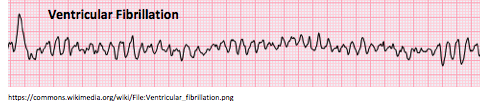 ventricullar fibrillation